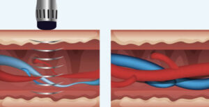 Shockwave Therapy
